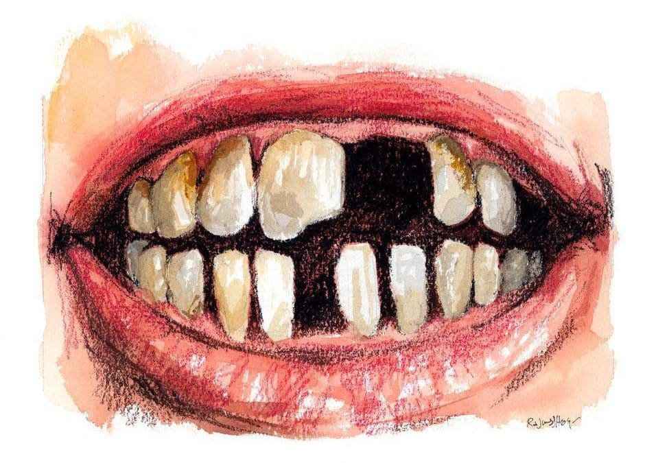 Dårlige tænder er en alvorlig sygdom